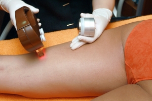 Does Laser Hair Removal Remove 100% of Hair? 